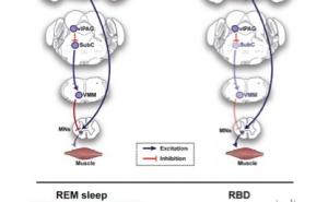 可怕的噩梦：快速眼动（REM）睡眠期行为障碍